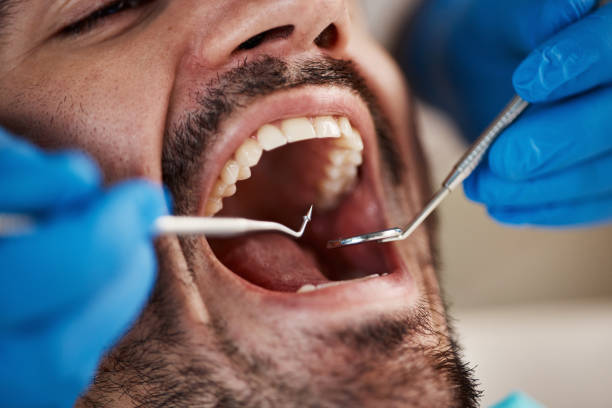 Best Broken or Cracked Tooth Emergency Dentist in Bluefield, WV