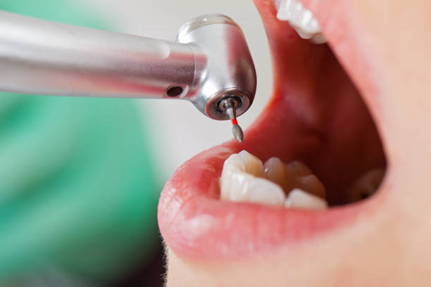 Best Emergency Dentist for Knocked-Out Tooth in Bluefield, WV